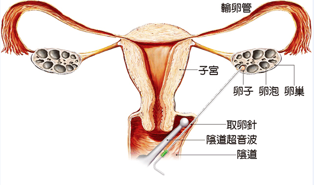 广州第三方生殖助孕取卵