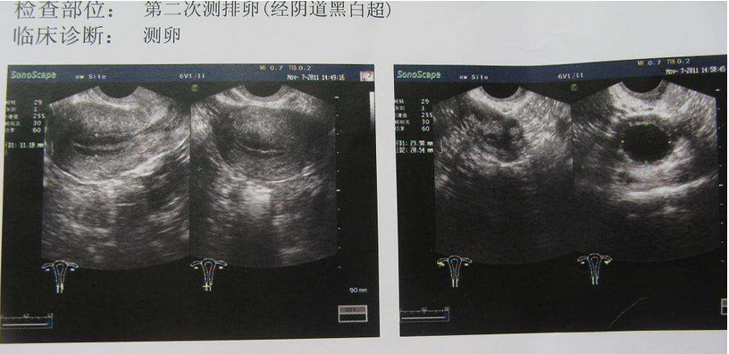 B超检测卵泡图