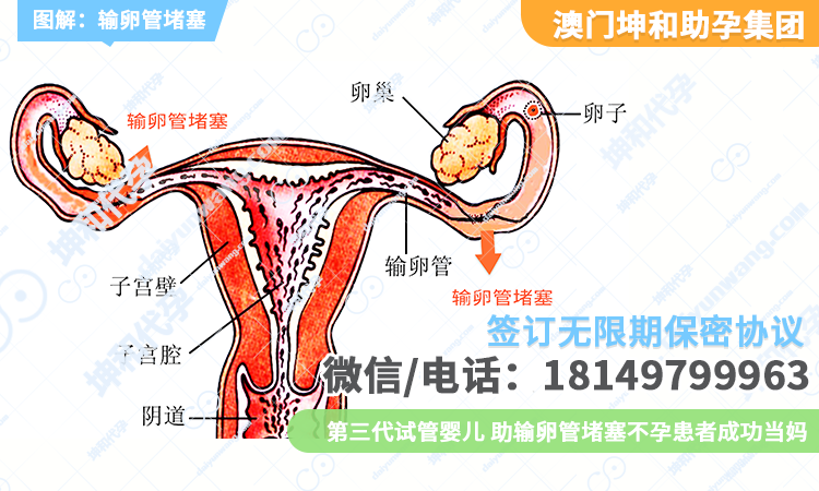 输卵管堵塞-2.png