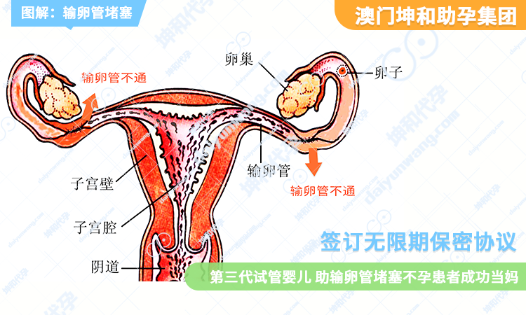 输卵管堵塞-1.png