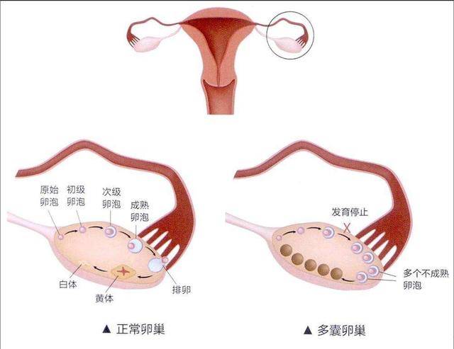 多囊卵巢